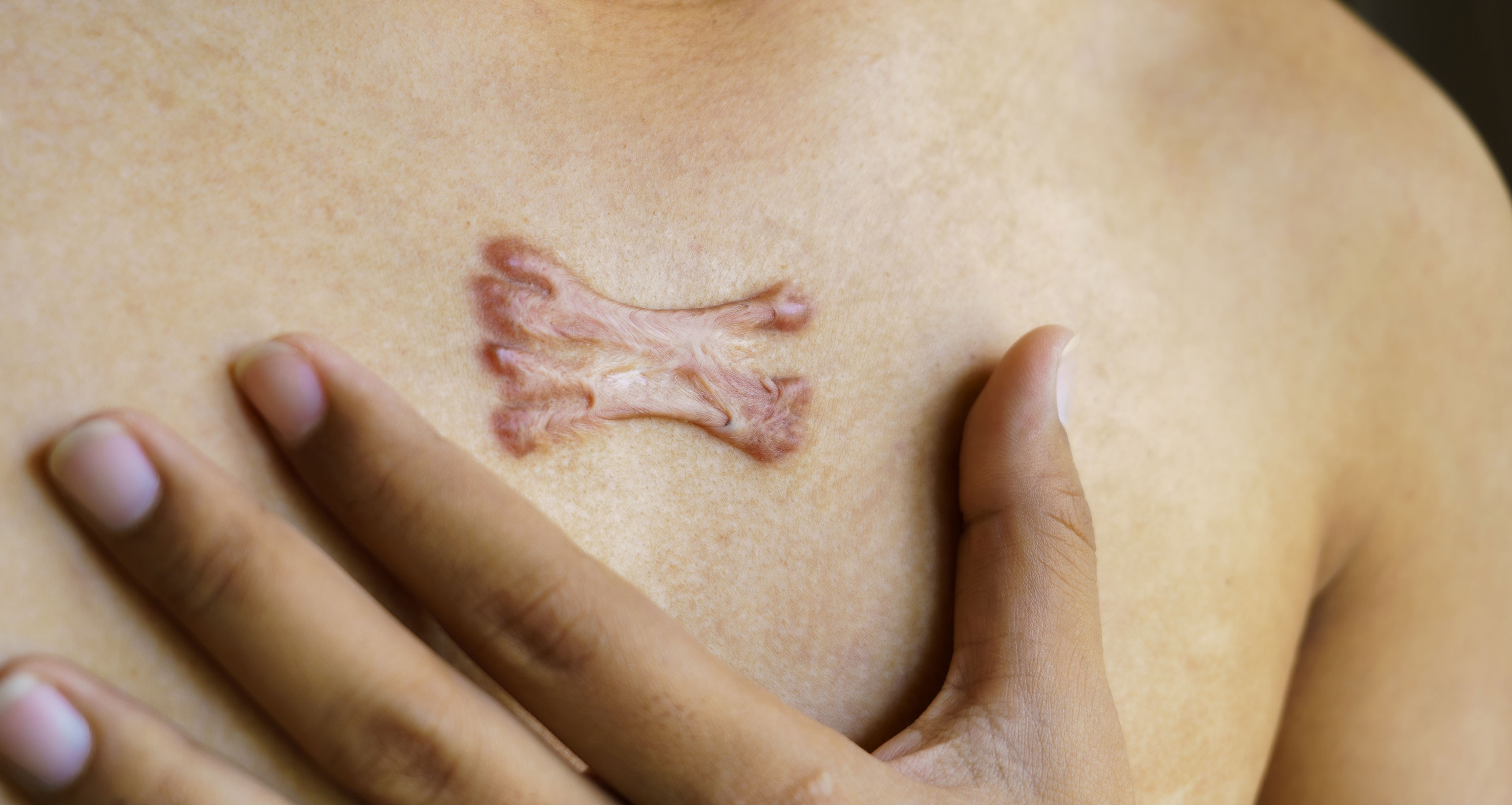 Understanding Keloid Scars