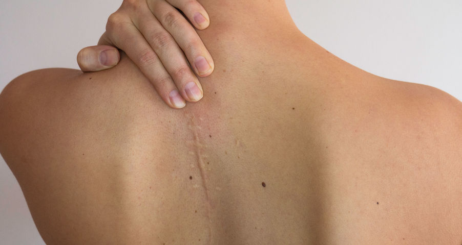 Facts about Hypertrophic Scars